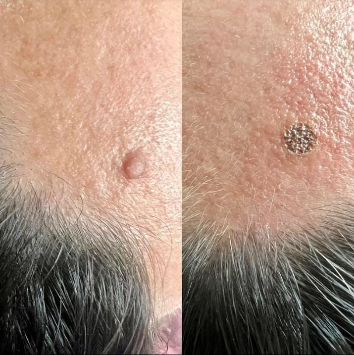 imagem remoção de sinais Valparaíso de Goiás